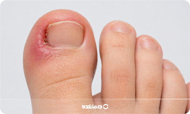 درمان سریع فرو رفتن ناخن در گوشت؛ علت، پیشگیری + روش جراحی