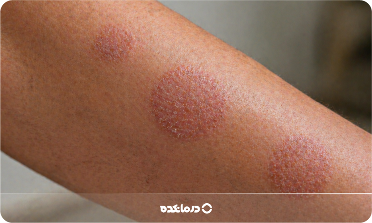 اگزمای دیسکوئید (سکه ای) چیست؟ علت، علائم + درمان قطعی