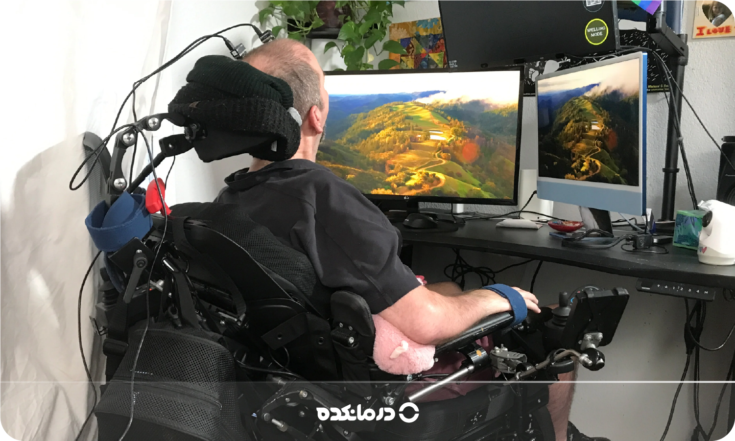 بیماری ALS اسکلروز جانبی آمیوتروفیک؛ علت، علائم + درمان