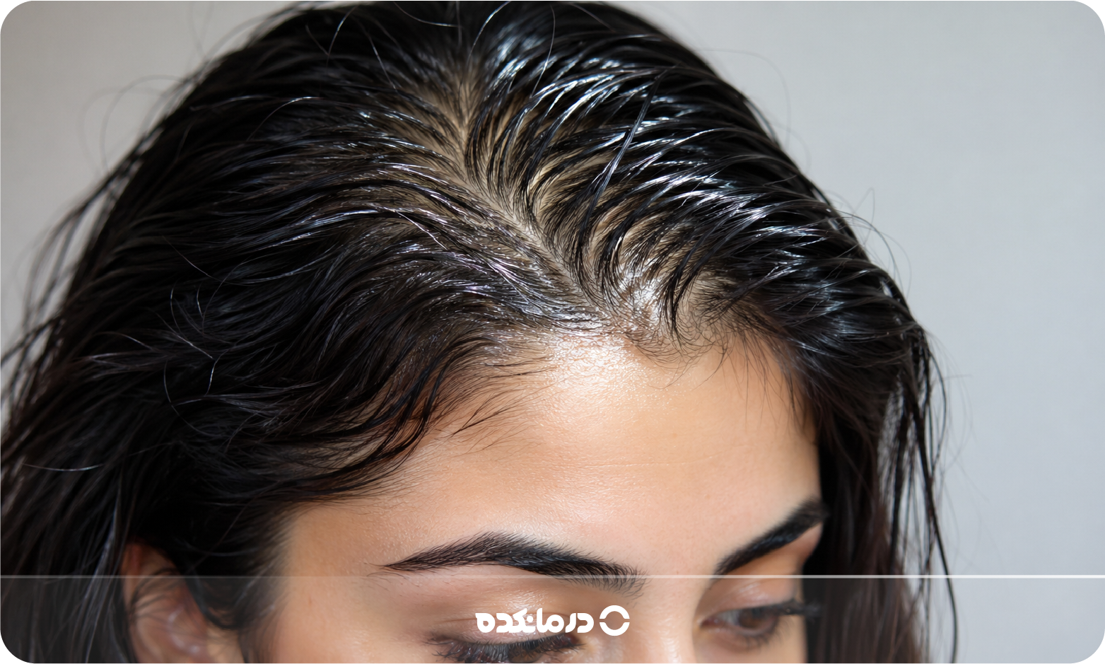 علت و درمان موی چرب [۱۳ راهکار خانگی درمان دائمی و قطعی]