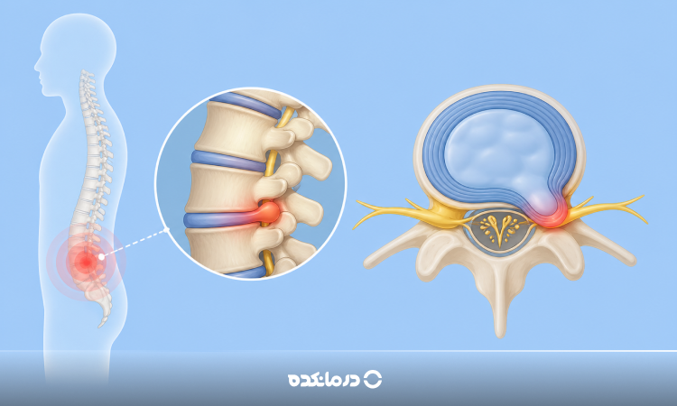 بیرون زدگی دیسک کمر چیست؟ از تشخیص تا درمان و پیشگیری