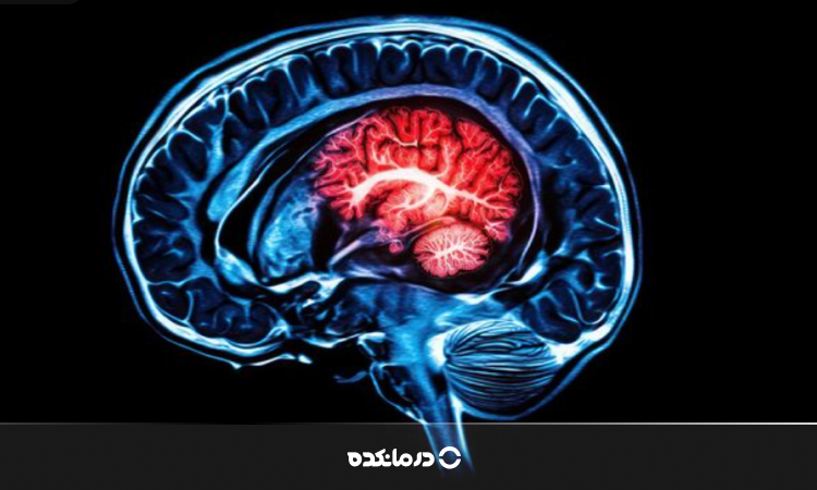 عوارض بعد از سکته مغزی خفیف و شدید چیست؟ بررسی ۱۵ پیامد مهم