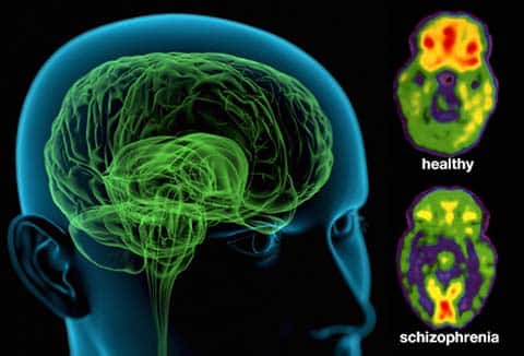 مغز افراد دارای اسکیزوفرنی