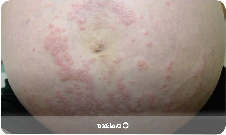 تصویر برجستگیهای قرمز کهیر روی شکم مادر باردار