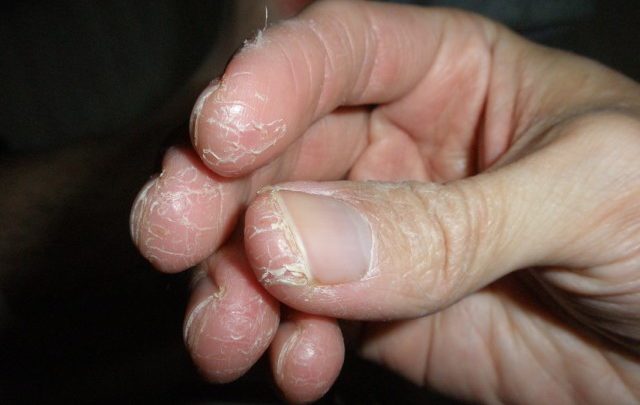 Cause-of-eczema-of-the-fingers1-640x405.jpg