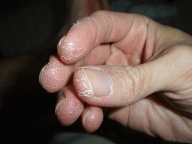 درمان اگزمای نوک انگشتان دست