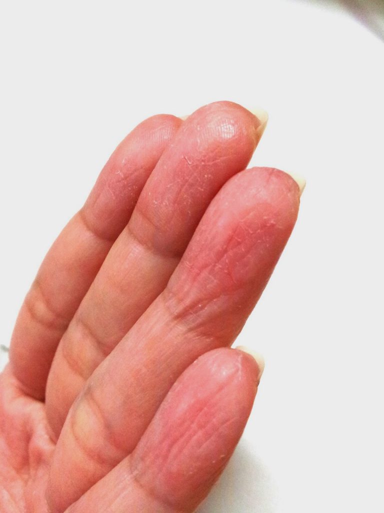 Cause-of-eczema-of-the-fingers2-768x1024.jpg