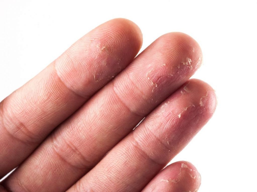 Cause-of-eczema-of-the-fingers3-1024x767.jpg