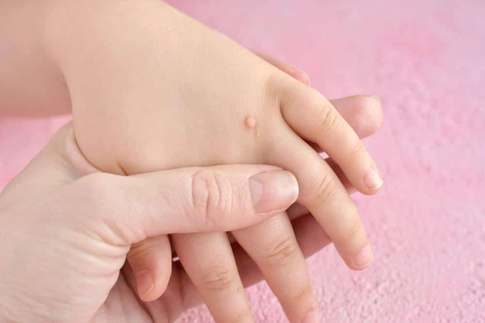 زگیل دست کودکان، 4 سوال مهم در مورد آن
