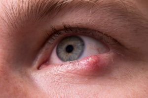 تبخال چشمی چیست و چه علائمی دارد؟