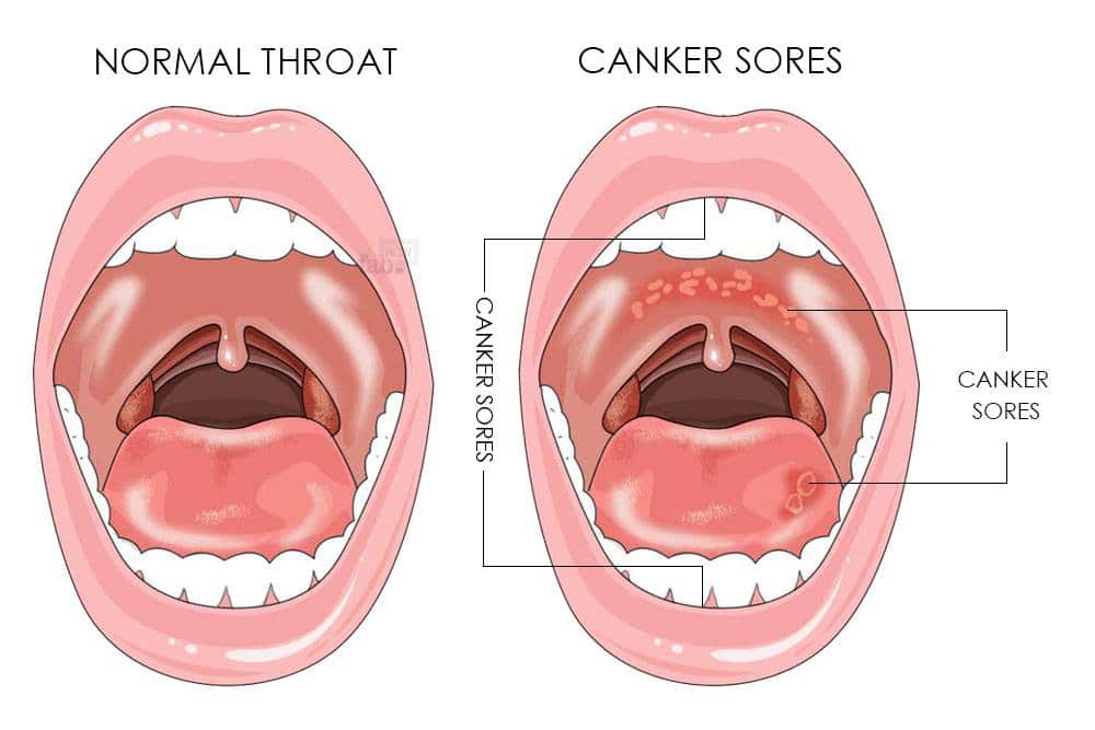 تبخال داخل دهان چه علائمی دارد و چگونه به وجود می‌آید؟