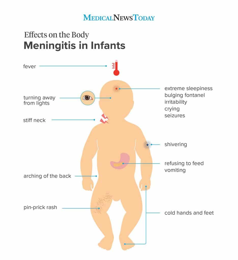 Meningitis-in-newborn-babies2-935x1024.jpg