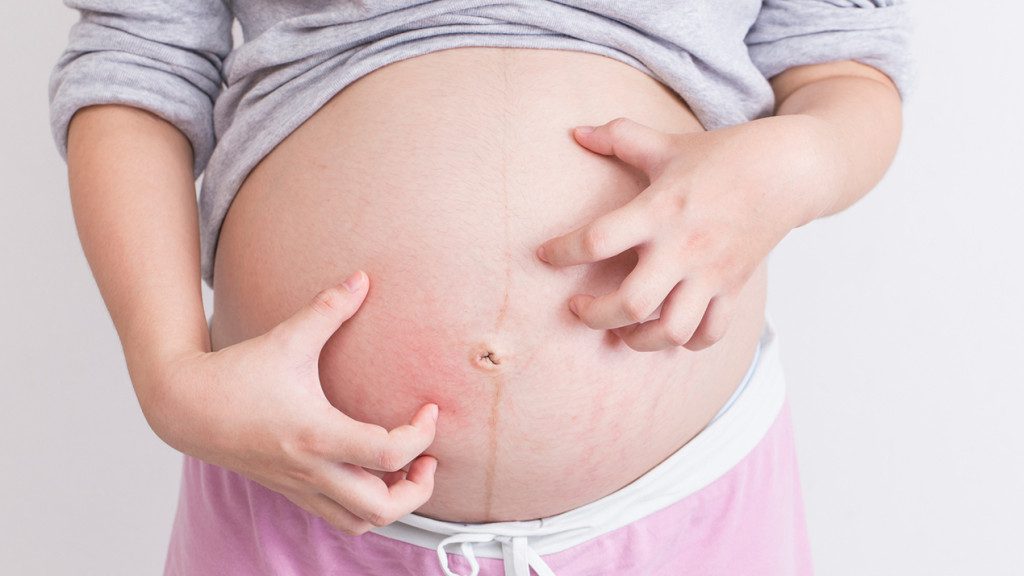 چرا خانم‎های باردار دچار کهیر پوستی می‏شوند؟