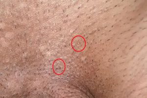 زگیل تناسلی را با زگیل معمولی اشتباه نگیرید