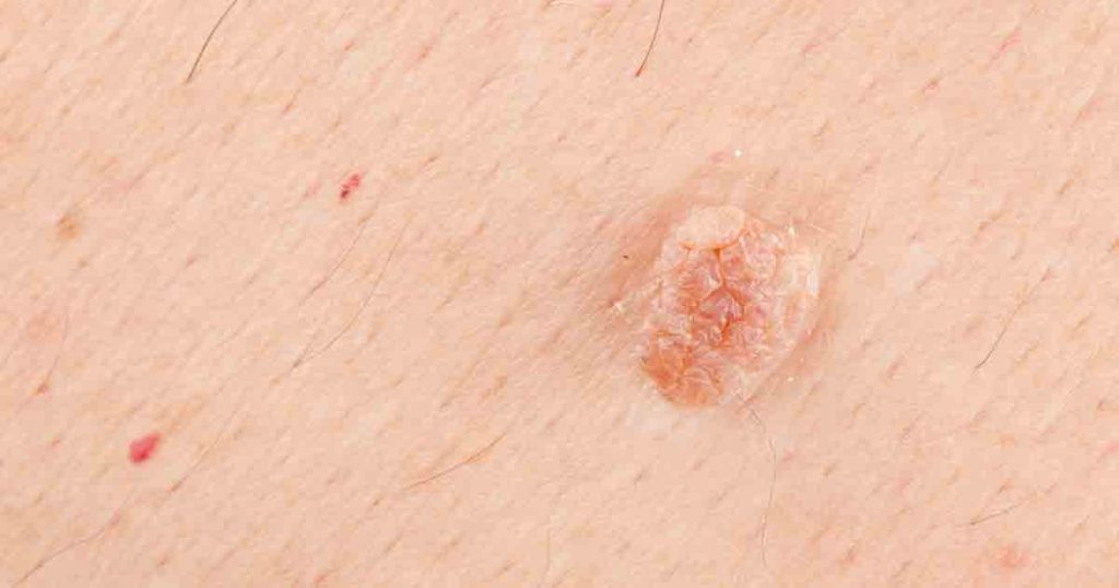 زگیل تناسلی چیست و چه شکلی دارد؟