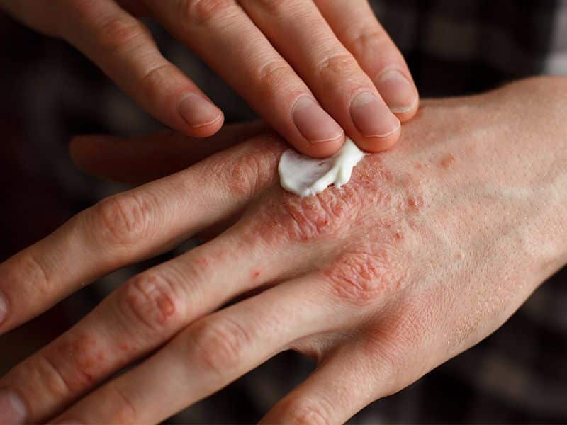 [عکس: Womens-hand-eczema2.jpg]