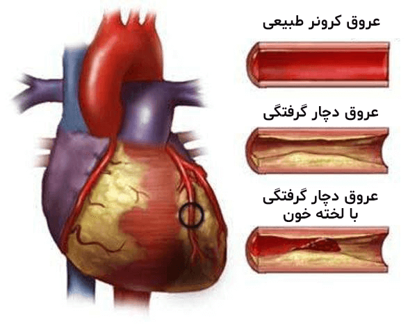 توضیح تصویری سکته قلبی به شکل ساده