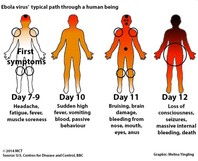 علائم ویروس ابولا