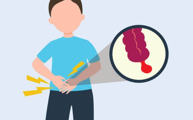 6 باور غلط راجع به آپاندیس