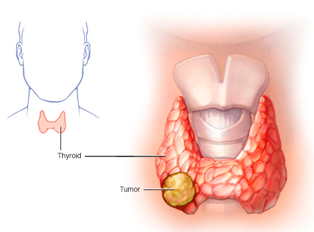 سرطان تیروئید ربطی به پرکاری تیروئید ندارد