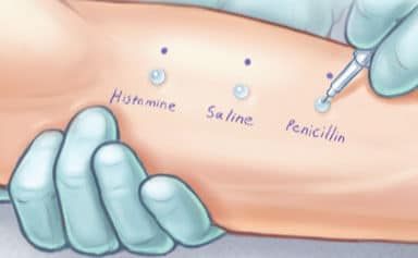 تست پوست برای تشخیص حساسیت به پنی سیلین