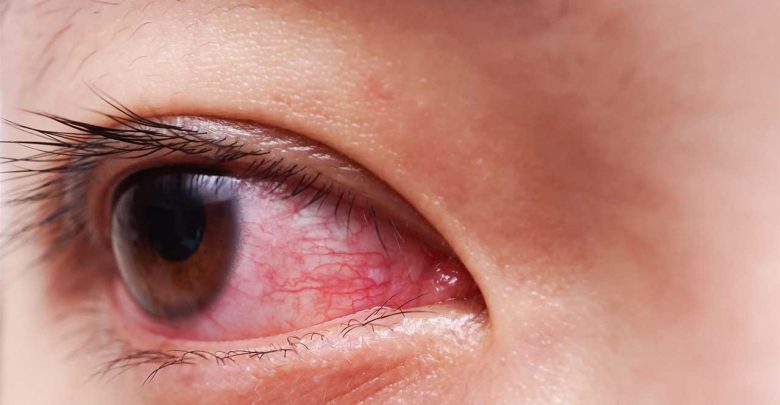 آیا قرمزی چشم از علائم کرونا می باشد؟