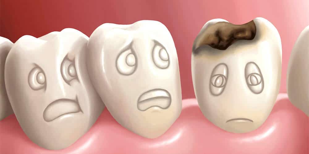 علت پوسیدگی دندان چیست؟ - درمانکده
