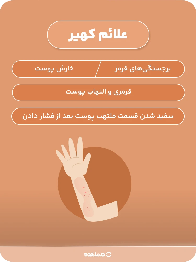 اینفوگرافیک علائم کهیر