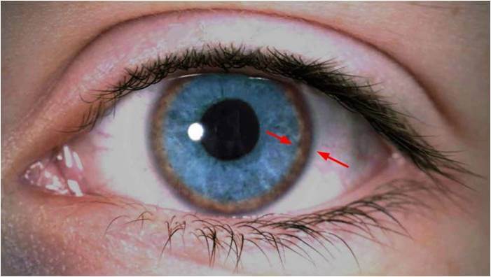تغییر رنگ بخشی از چشم به رنگ مس نشانه ابتلا به بیماری ویلسون می‌باشد.