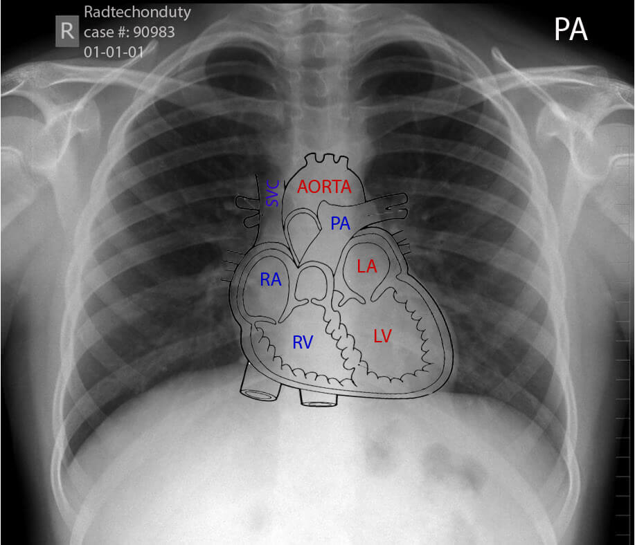 مشاهده مشکلات احتمالی مرتبط با قلب با انجام رادیوگرافی سینه