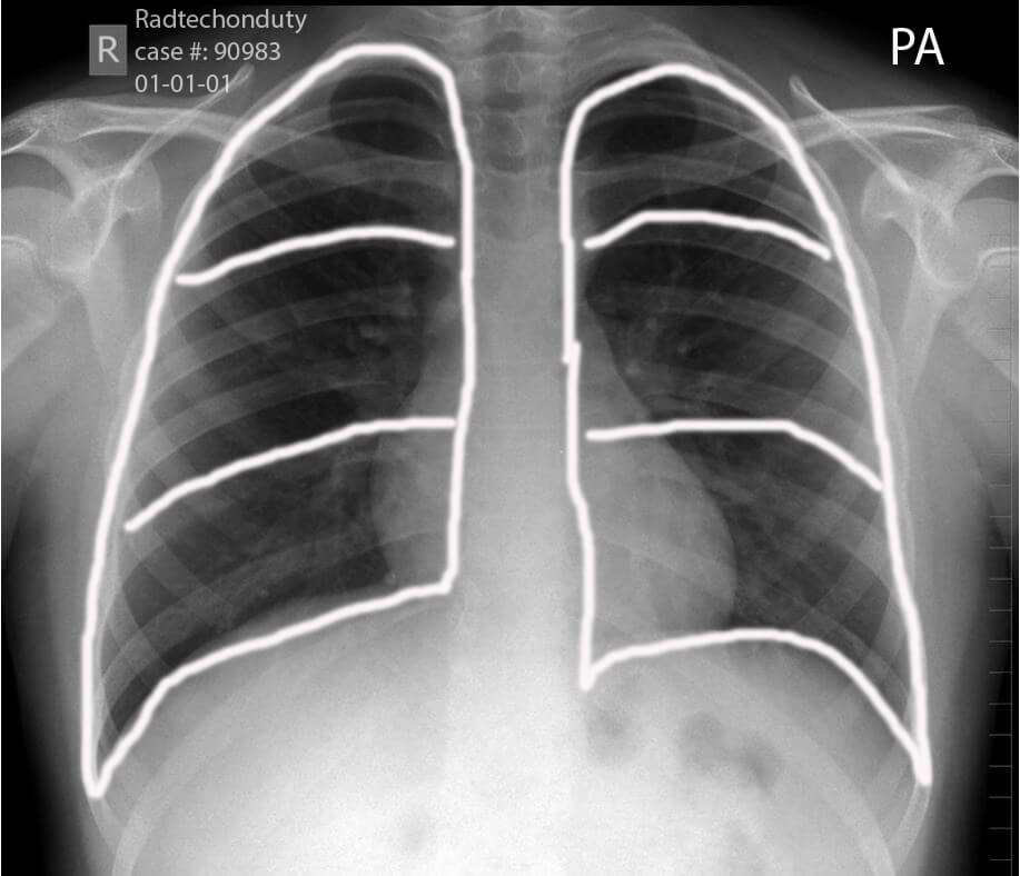 مشاهده دقیق وضعیت ریه با انجام رادیوگرافی سینه