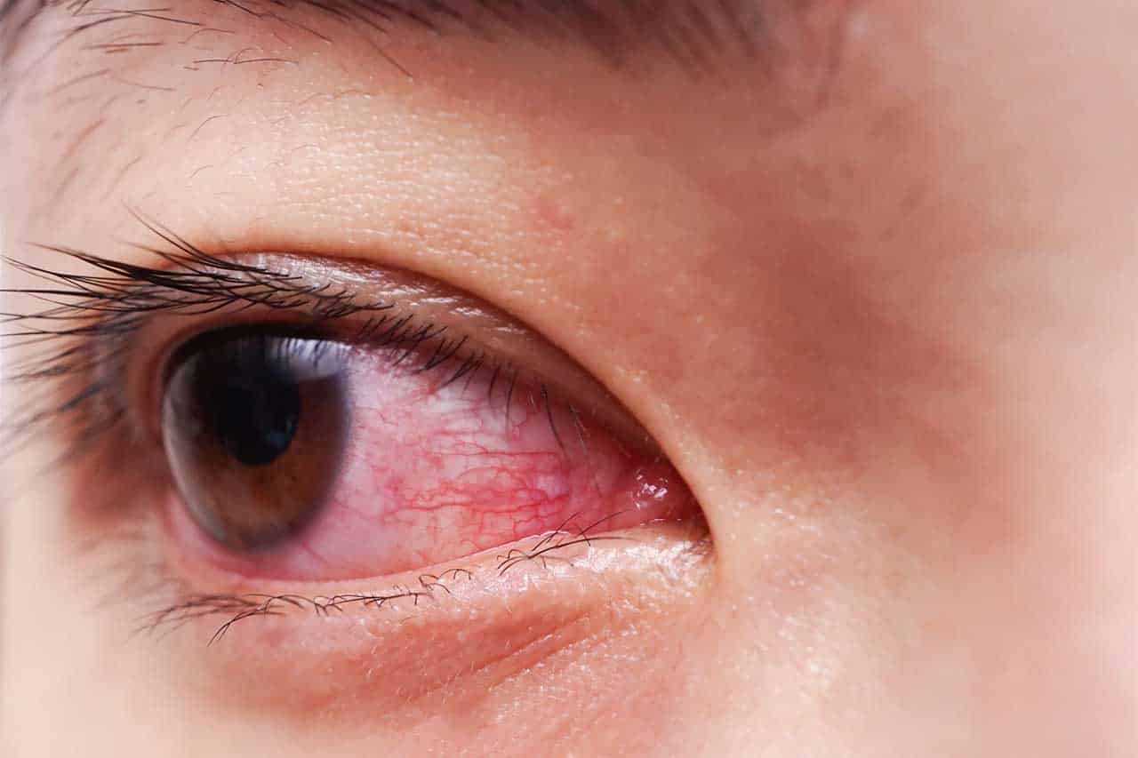 قرمزی چشم و کرونا