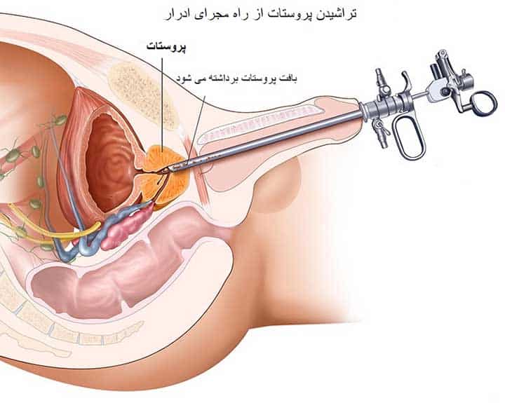 نمونه برداری از پروستات