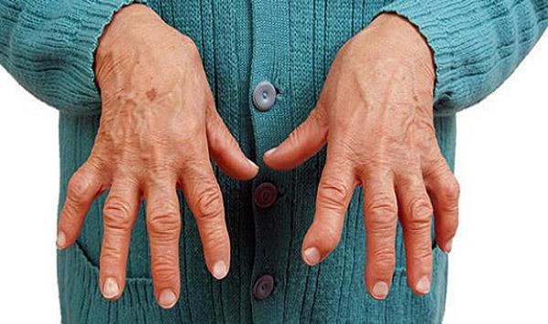 علائم روماتوئید و نشانه های اولیه آن - درمانکده