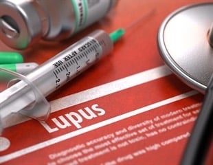 درمان قطعی برای لوپوس نیست