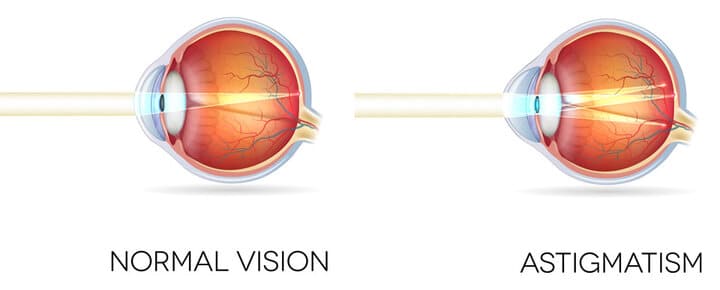 مطالعه در نور کم آسیب به قرنیه چشم و بینایی وارد می‌کند که البته ربطی به آستیگماتیسم ندارد.