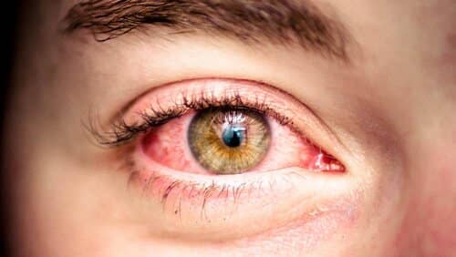 از نشانه‌های خستگی چشم، قرمز و ملتهب شدن چشم است.