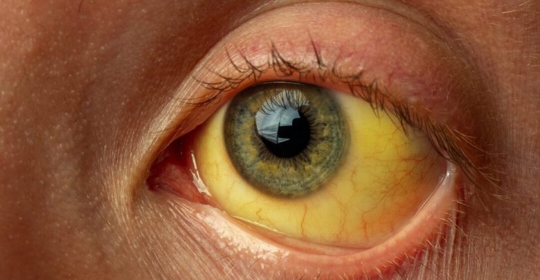 یرقان اصطلاحی است که برای توصیف رنگ پوست و سفیدی چشم مایل به زرد به کار می‌رود.
