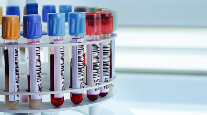 آزمایش خون از بهترین روش‌های ممکن برای ارزیابی ریز به ریز عملکردهای بدن و سلامت آن از طریق ارزیابی خون است.