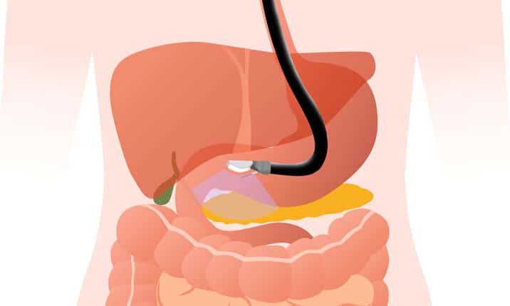 شیوه کار دستگاه آندوسکوپی EUS