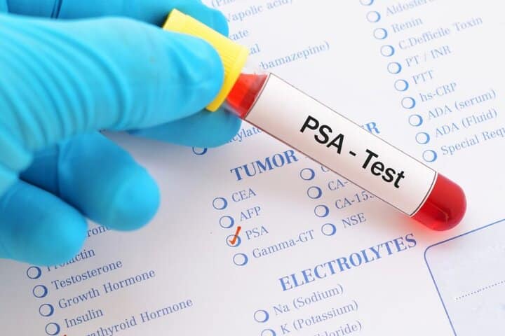 عوامل زیادی روی PSA تاثیر دارد بنابراین نتایج آزمایش باید به‌دقت توسط متخصص ارزیابی شود.