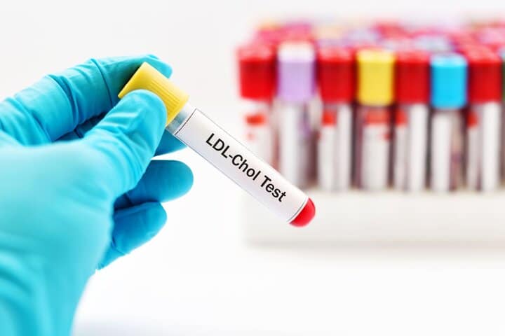 آزمایش LDL تنها به یک نمونه خون ساده نیاز دارد. ممکن است این فرآیند، رگگیری یا خونگیری نیز نامیده شود.