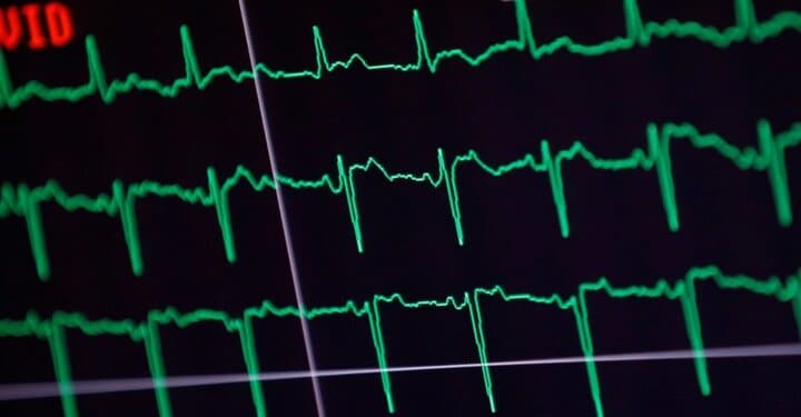الکتروکاردیوگرام (EKG) فعالیت الکتریکی قلب شما را می‌سنجد و عملکرد قلب را ارزیابی می‌کند.