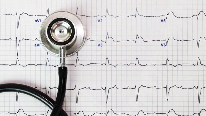 طی حمله قلبی قسمتی از بافت می‌میرد و اکتروکاردیوگرام نشان می‌دهد که الکتریسیته از آن عبور نمی‌کند.