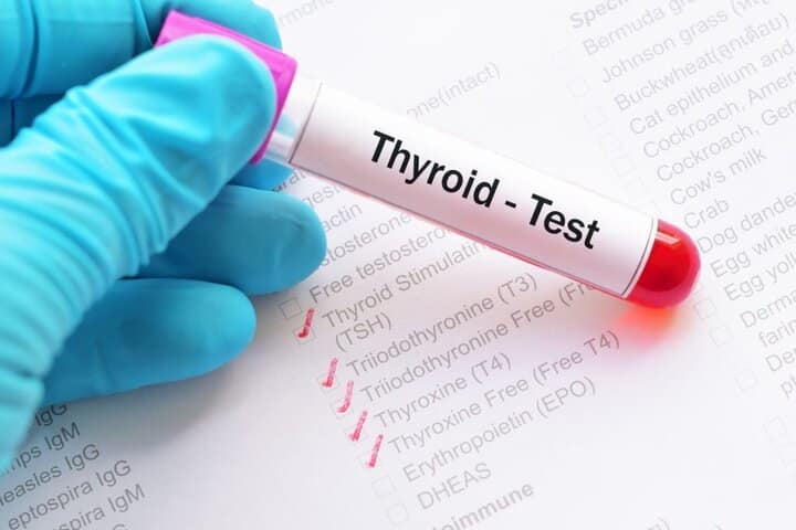 برای اندازه‌گیری سطح TSH و میزان هورمون غده تیروئید به نام تیروکسین تا علت‌یابی کلسترول غیرنرمال، یک آزمایش خون انجام خواهد شد.