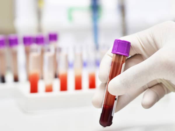 مقدار زیاد LDL سبب تجمع کلسترول در شریانهای شما میشود
