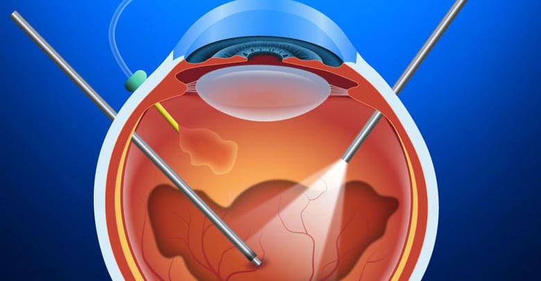 همه چیز درباره عمل جراحی ویترکتومی چشم