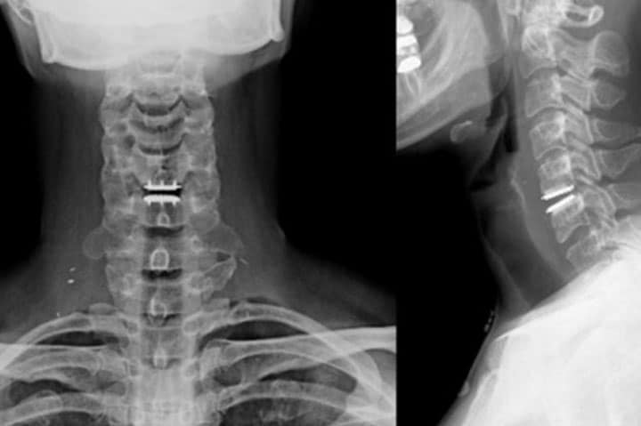 جراحی دیسک گردنی