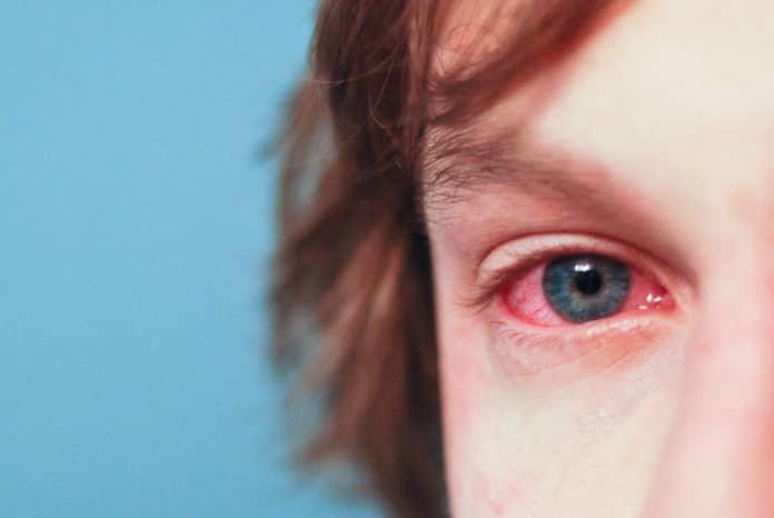 آلرژی شدید می‌تواند روی وضعیت چشم‌ها نیز اثر بگذارد.