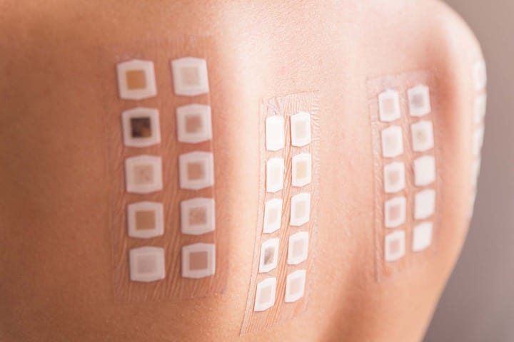 یکی دیگر از آزمایش‌های پوستی آزمایش تکه‌ای است که این آزمایش آلرژی با استفاده از یک تکه چسب حاوی آلرژن‌ها و قراردادن آن بر روی پوست انجام می‌شود.